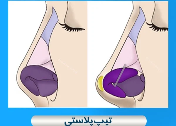 عمل بینی فرق تیپ پلاستی با عمل بینی