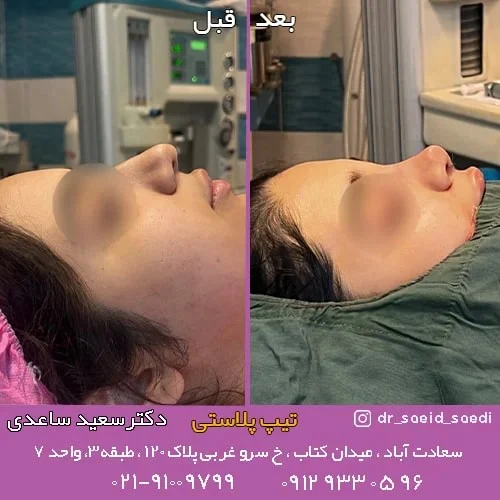 فرق تیپ پلاستی با عمل بینی