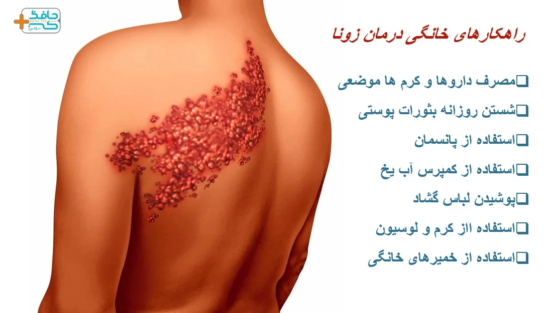 راهکارهای خانگی درمان زونا